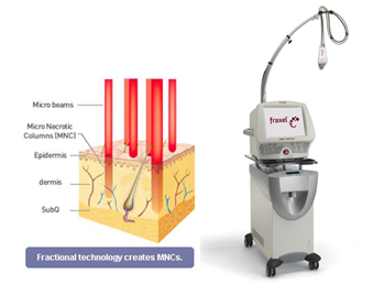 Hitt | “Microneedle Ablative Fractional RF”