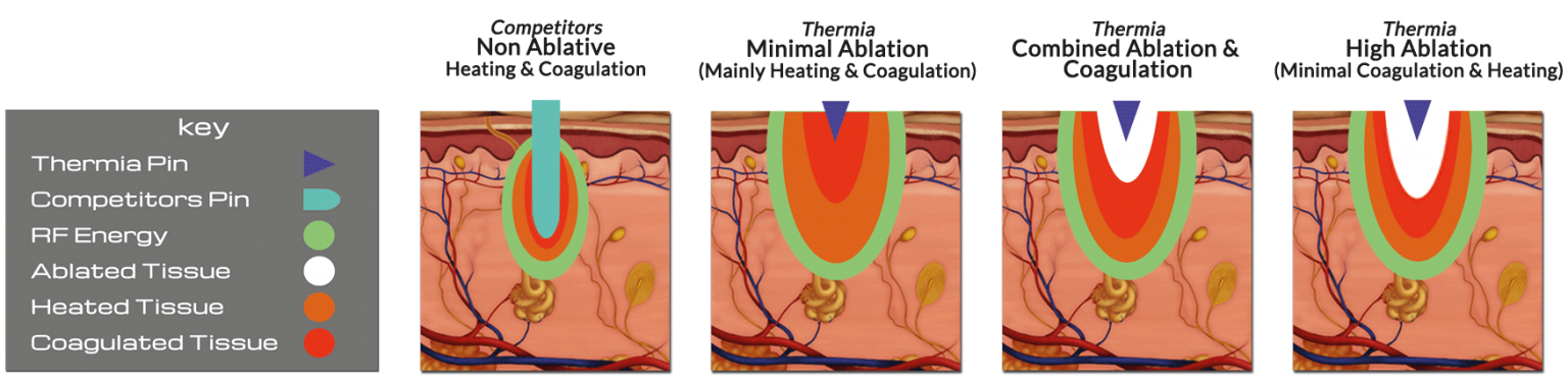 Ablation value can be controlled up to a maximum of 500 microns, coagulation and heat affected area up to 4 mm, and the variable energy density will have the advan- tages of fractional laser treatment.