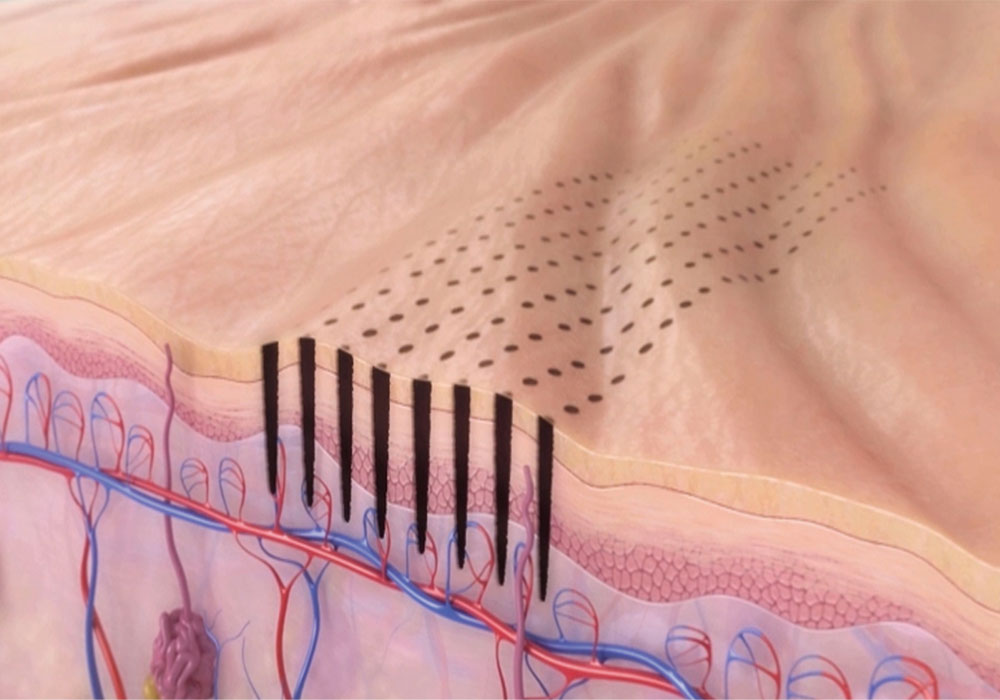 After the penetration of needles into skin, RF waves are sent by a number of needles and the rest of needles receive the RF.